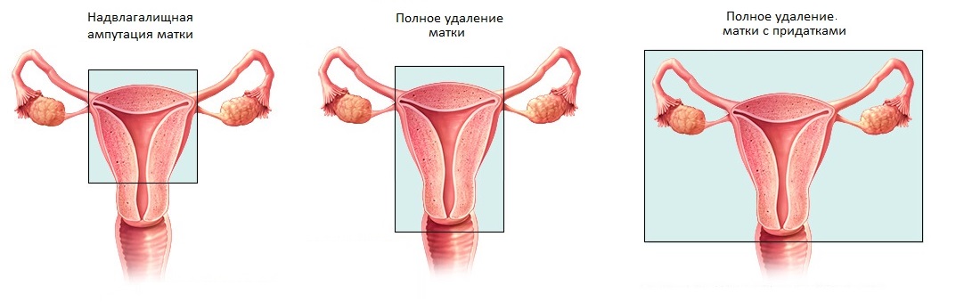 Ампутация матки