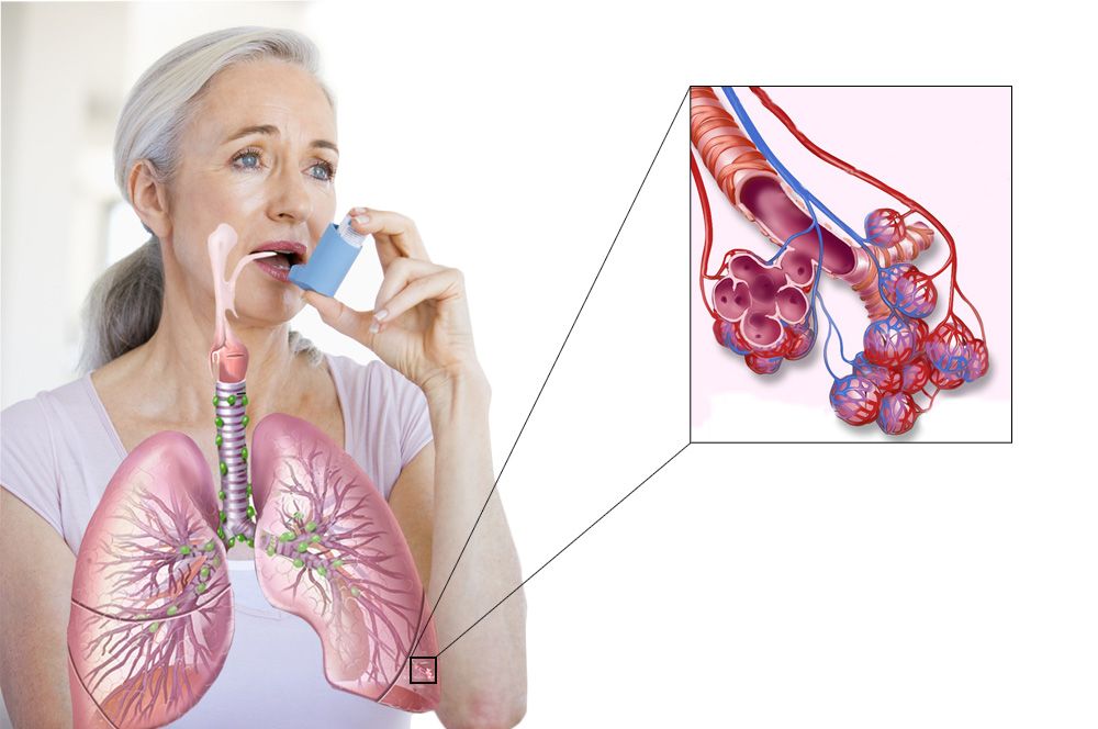 Бронхиальная астма: лечение у взрослых