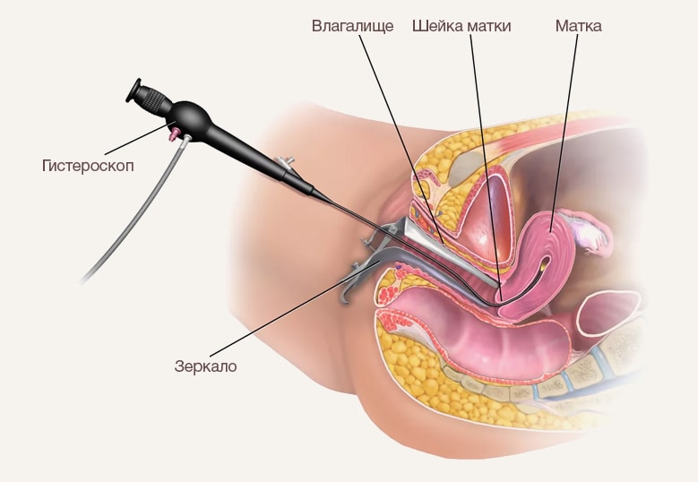 Гистероскопия