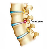 Что такое межпозвоночная грыжа?