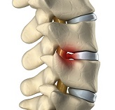 Грыжа позвоночника