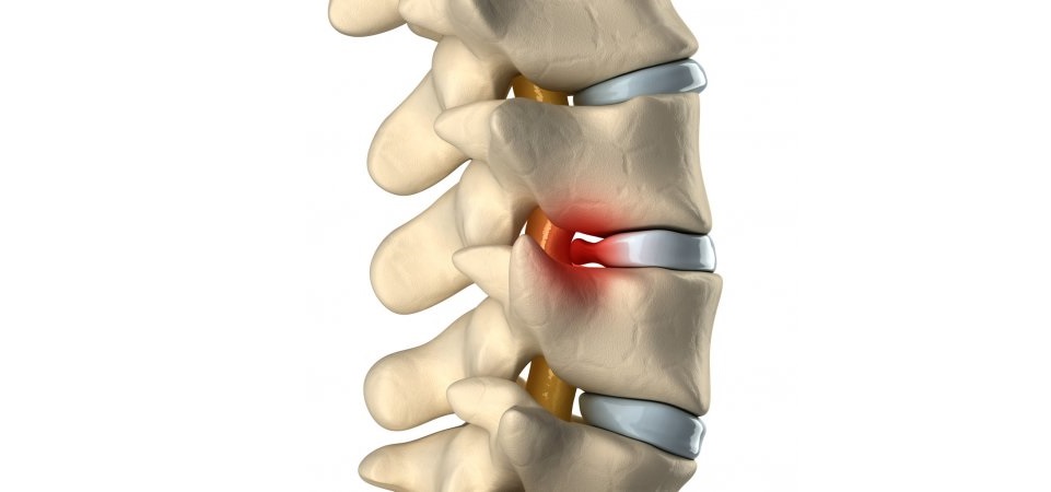 Грыжа позвоночника