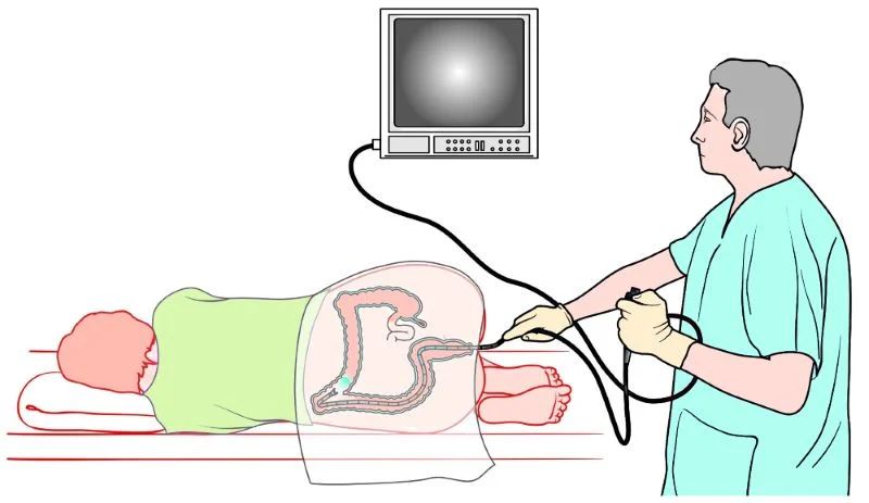 kolonoskopia procedyra