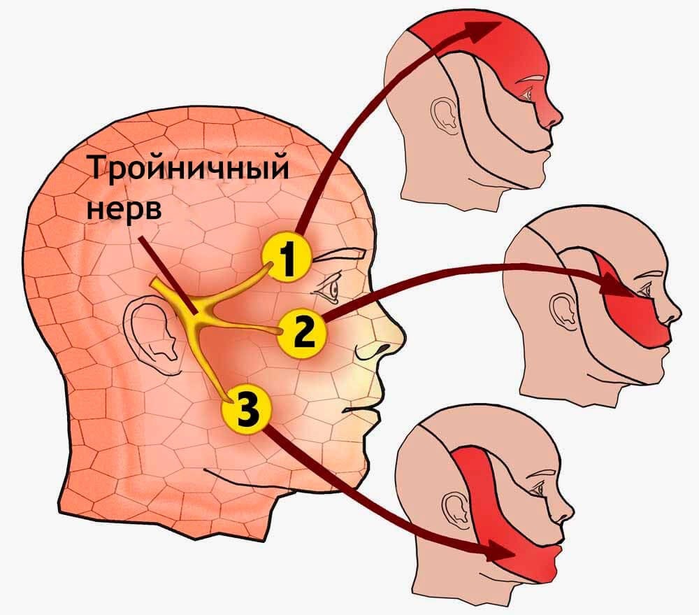 Воспаление тройничного нерва