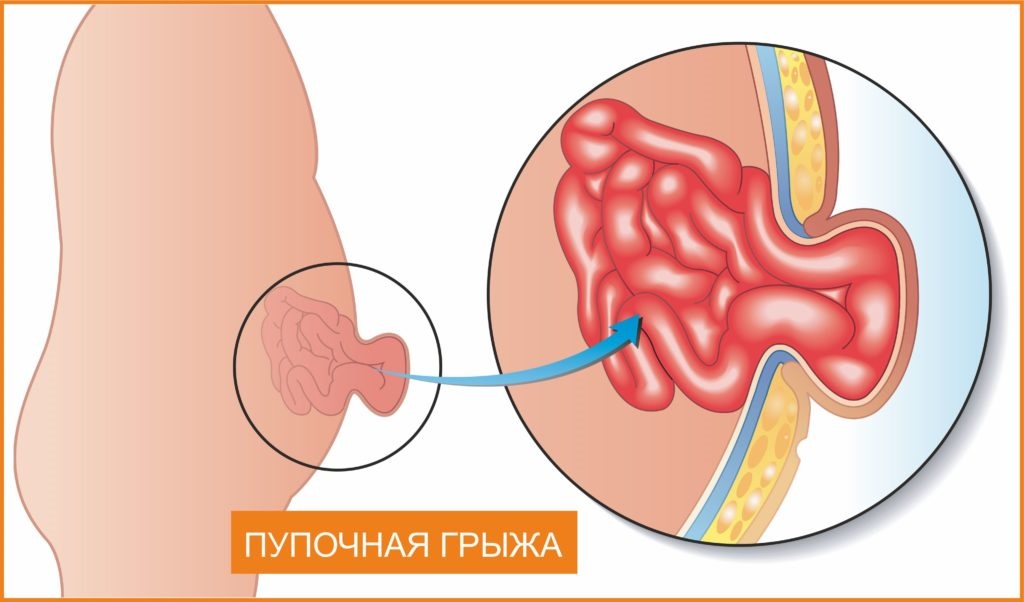 Профилактика пупочных грыж у ребенка