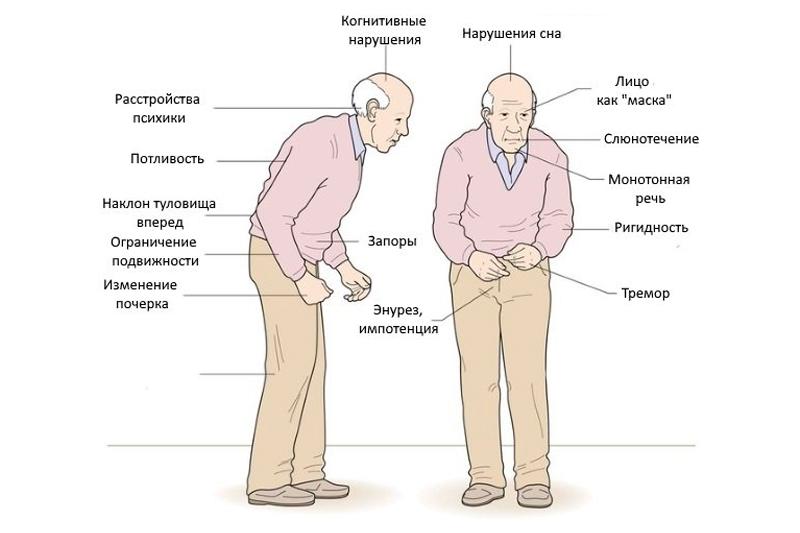 симптомы болезни Паркинсона