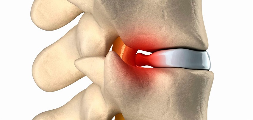 УДАЛЕНИЕ ГРЫЖИ МЕЖПОЗВОНКОВОГО ДИСКА