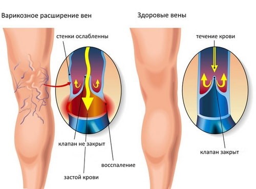 Варикозное расширение вен на ногах лечение минск