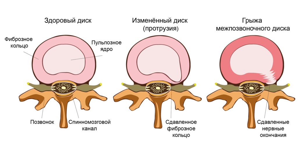 Симптомы грыжи межпозвоночного диска