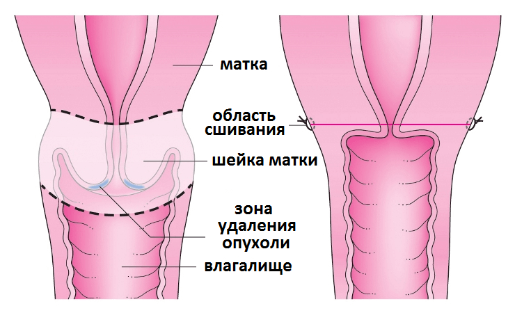 Высокая ампутация шейки матки