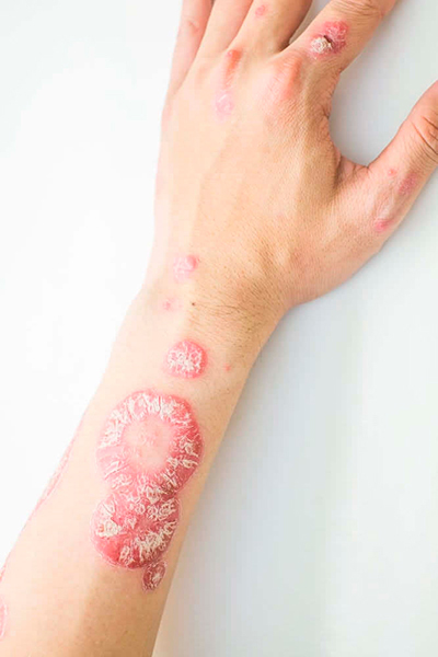 191029 psoriase 02