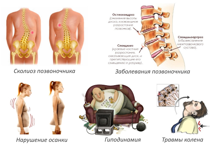 Снижение высоты межпозвоночных дисков причины симптомы лечение