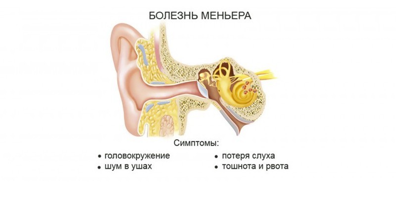 Синдром Меньера