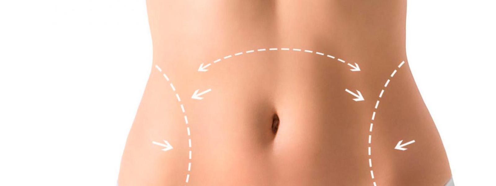 Abdominoplasty