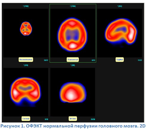 Однофотонная эмиссионная компьютерная томография головного мозга в определении степени гипоперфузии у пациентов с вертебробазилярной недостаточностью, вызванной позиционными нарушениями кровотока в задней черепной ямке
